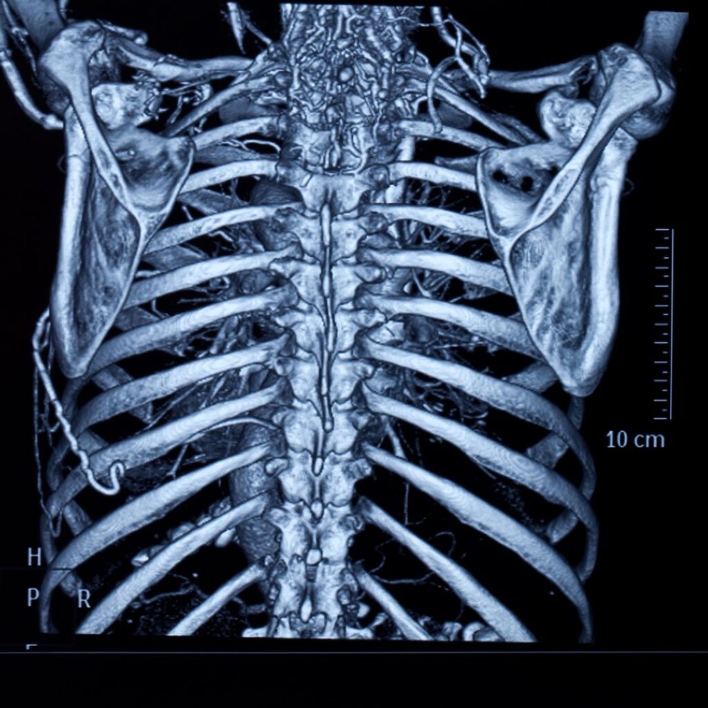 変形性膝関節症と胸郭の関係― 痛みの背景にある“全身のつながり”とは？ ―