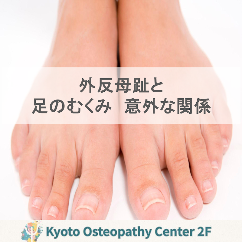 外反母趾と足のむくみ:変形の“背景”を見逃さない